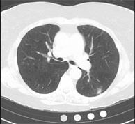 lung nodule