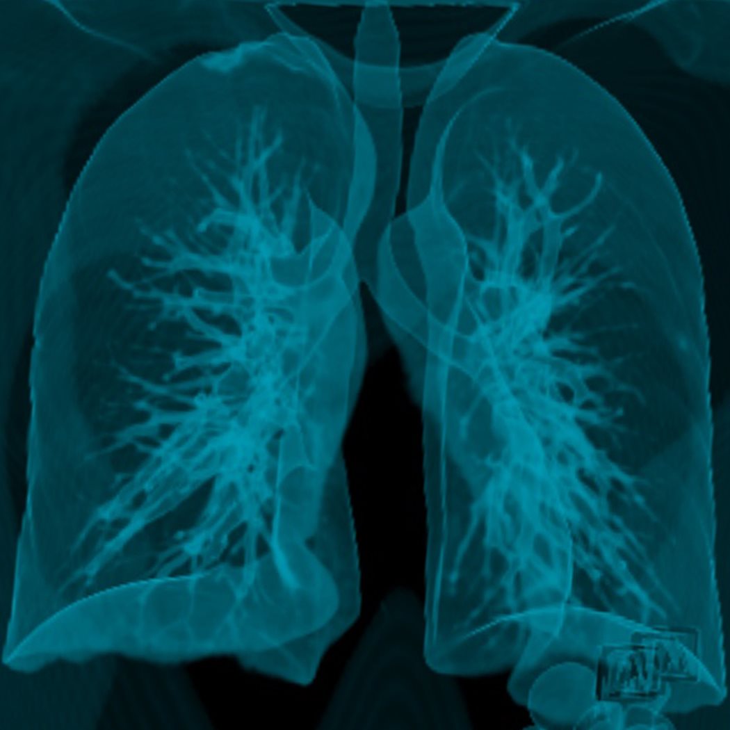 Lung - 3d image