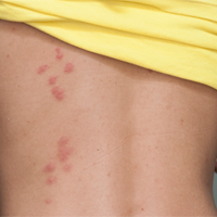 Skin Reaction to Bedbug bites