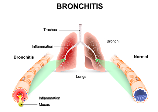 Bronchitis illustration