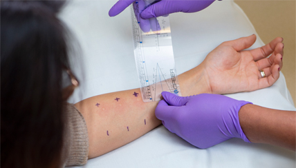 Allergy Testing