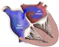 intracardiac shunt