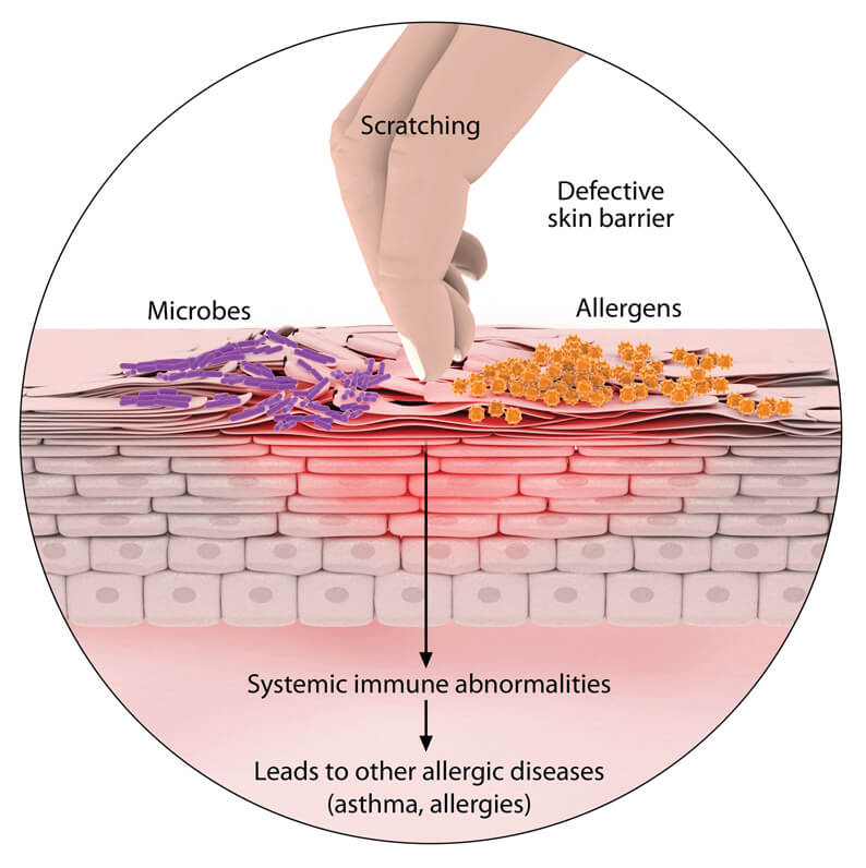 eczema vs dermatitis karcolja a bőrt vörös foltok és hólyagok jelennek meg