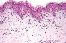 Epstein-Barr virus has been thought to predispose people to autoimmune diseases such as lupus and multiple sclerosis because it more commonly infects people with those diseases.