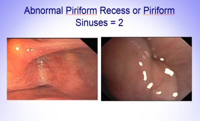 Piriform Recess 2