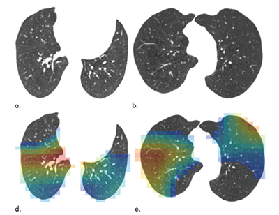 CT scan of lungs and smoking damage