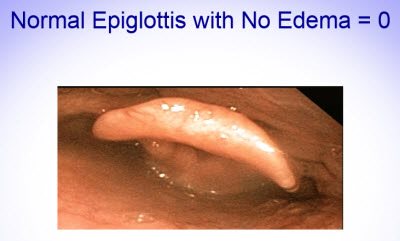 Scoring Epiglottis 1