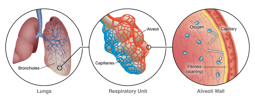 Diagram of ILD