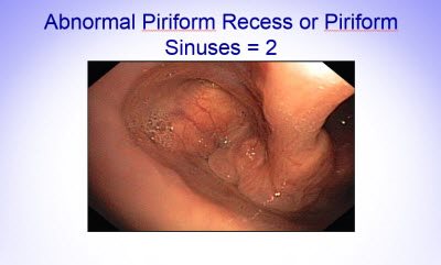 Piriform Recess 3