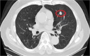 The circled item is a nodule or spot on the lung. Most lung nodules are not cancerous.