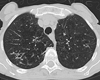 COPD CT