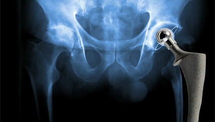 metal hip joint